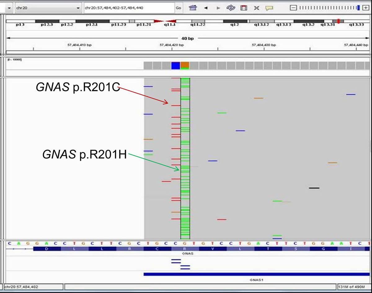 Two single base pair substitution mutations in GNAS gene in separate alleles (or clones) causing two different amino acid changes (indicated by arrows)